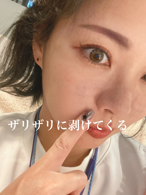 毛穴撲滅し隊なのでフラクショナルco2レーザーをやってみた 笹本真理子の美意識過剰blog