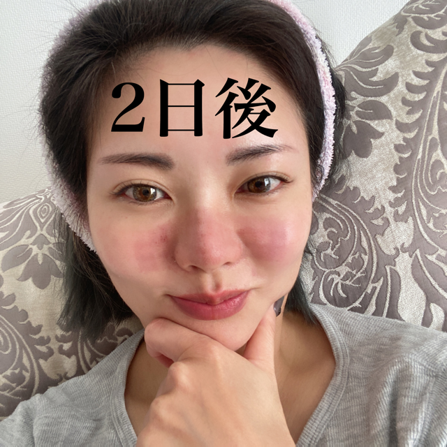 毛穴撲滅し隊なのでフラクショナルco2レーザーをやってみた 笹本真理子の美意識過剰blog