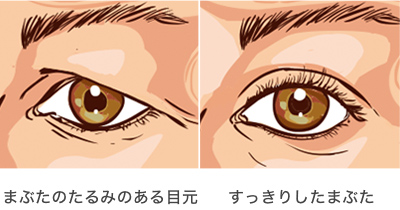 まぶたのたるみ